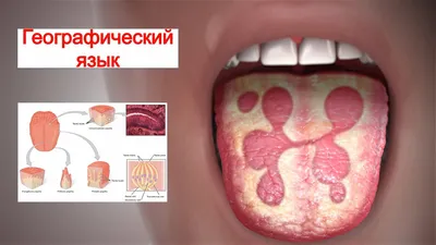 Географический Язык (Доброкачественный Мигрирующий Глоссит) - YouTube