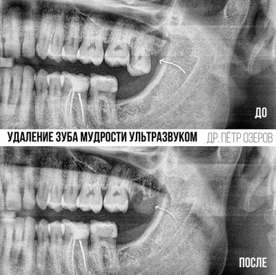Удаление зуба мудрости ультразвуком Piezosurgery®. Без боли.