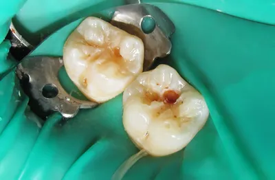 Как стоматологи удаляют корень зуба мудрости сверху и снизу – можно ли  вырвать его самостоятельно (самому) в домашних условиях или лучше вытащить  заросший осколок в стоматологии