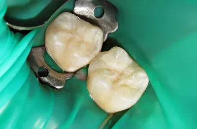Как стоматологи удаляют корень зуба мудрости сверху и снизу – можно ли  вырвать его самостоятельно (самому) в домашних условиях или лучше вытащить  заросший осколок в стоматологии