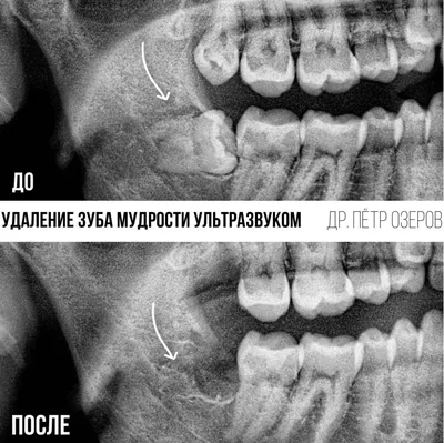 Удаление зуба мудрости ультразвуком Piezosurgery®. Без боли.