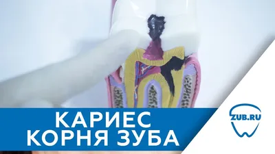 Кариес корня зуба - причины, симптомы, лечение, профилактика