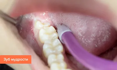 Удаление корня зуба — методика, как удаляют зуб если остался только корень,  показания