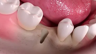 Что делать если выпал коренной зуб, Имплантация, мостовидные протезы,  протезы-бабочки. Сравнение методов | Стоматология Dентал Мир