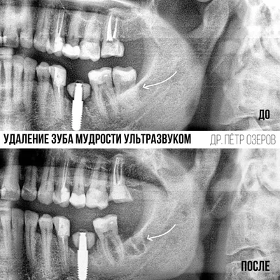 Удаление зуба мудрости ультразвуком Piezosurgery®. Без боли.