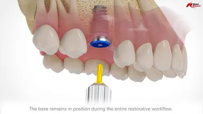 Зубные импланты Nobel Biocare — установка, отзывы пациентов, страна  производитель (Швейцария)