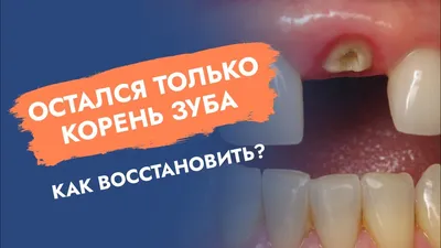 Остался только корень зуба. Как восстановить? - YouTube