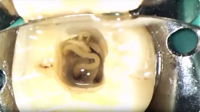 Удаление гноя из канала зуба, Острый гнойный периодонтит. - YouTube