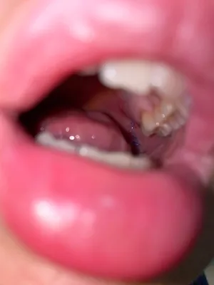 Разошелся шов после удаления зуба - Вопрос стоматологу - 03 Онлайн
