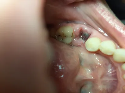 Удаление зуба с гранулемой - Вопрос стоматологу - 03 Онлайн