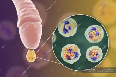Гонорея инфекции, вызванной бактериями Neisseria гонореи в мужском органе  во время уретрита, цифровая иллюстрация . — микробные, здравоохранение -  Stock Photo | #274957636