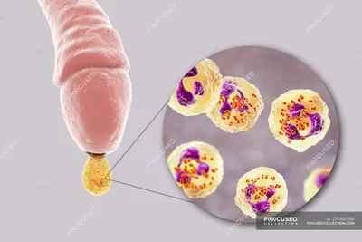 Гонорея инфекции, вызванной бактериями Neisseria гонореи в мужском органе  во время уретрита, цифровая иллюстрация . — передается половым путем,  Инфекция - Stock Photo | #274960986