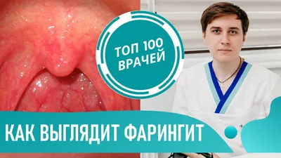 Симптомы ТОНЗИЛЛИТА. Первые признаки ангины у детей и взрослых. Как  выглядит горло при ангине - YouTube