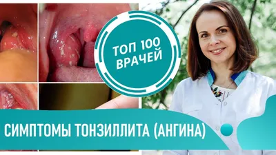 Симптомы ТОНЗИЛЛИТА. Первые признаки ангины у детей и взрослых. Как  выглядит горло при ангине - YouTube