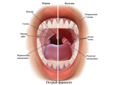 Как я победил хронический фарингит: лечение гомеопатией - Электронный  журнал «Женщина Москва»
