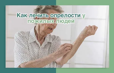 Как лечить опрелости у пожилых людей | Дом престарелых \