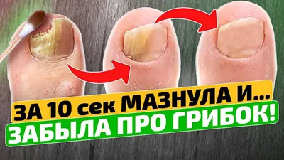 Как я навсегда уничтожила грибок ногтей! Грибок ногтей на ногах лечение в  домашних условиях | Лечение ногтей, Лечение, Ногти на ногах
