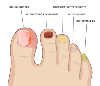 Грибок на ногтях Грибок на ногтях (онихомикоз ногтей) это неприятное  заболевание, которое может превратиться в самую настоящую проблему, если  всерьёз не взяться за лечение. Споры разрушают роговые