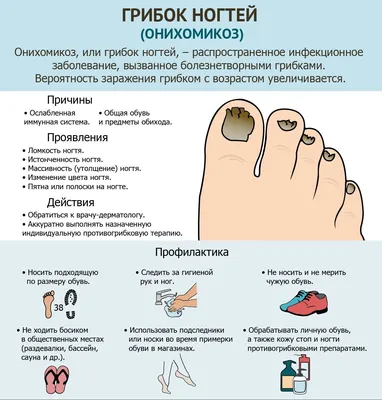 Грибок ногтей на ногах симптомы - 63 photo