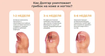 5 отличий онихолизиса ногтей от грибковой инфекции