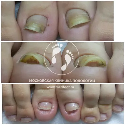 Дистрофия ногтевой пластины после удаления ногтя | Московская Клиника  Подологии