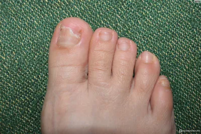Противогрибковое средство Фармтек Лосьон для ногтей Микостоп - «Реально ли  вылечить грибок ногтей без таблеток? Фото грибка ногтей.» | отзывы