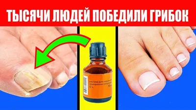 Купить Как вылечить грибок на ногтях ног? NormaDerm от грибка ногтей, цена  179 грн — Prom.ua (ID#1254699557)