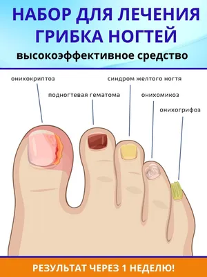 Комплекс для лечения грибка ногтей Xi Fei Shi 63061132 купить в  интернет-магазине Wildberries