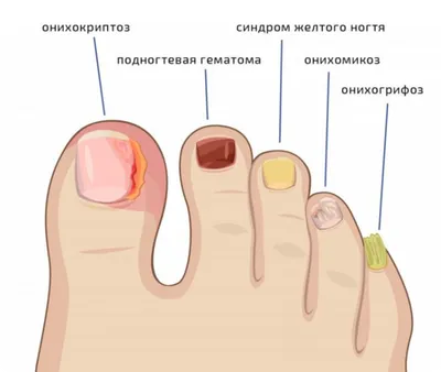 От чего может возникнуть грибок ногтей? - Proexpress.com.ua