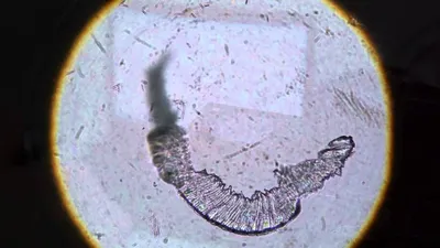 Клещ демодекоза, грибок ногтей - как они выглядят в лаборатории - YouTube