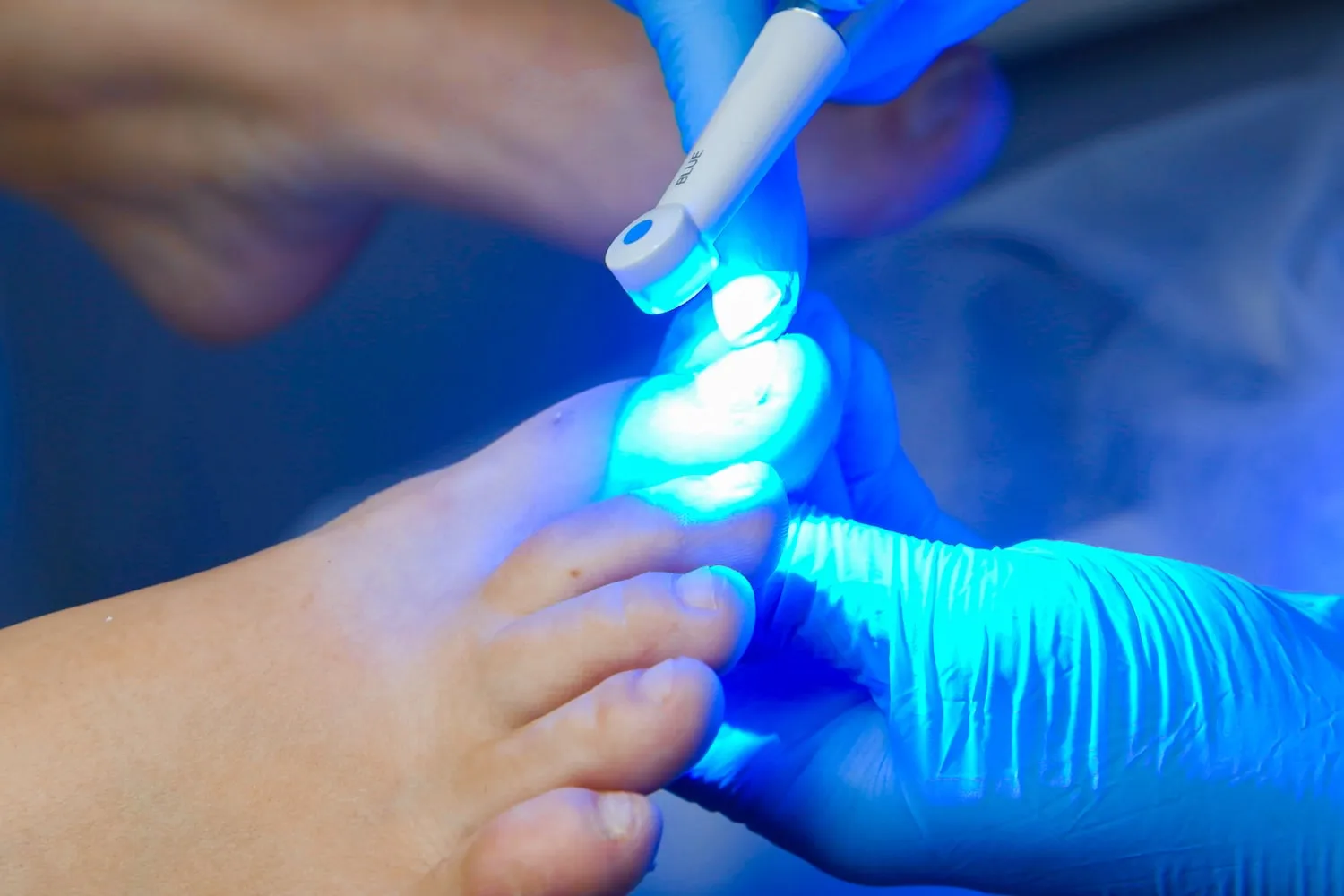 Доктор по ногтям. Дерматоскопия лампа Вуда. Фотодинамическая терапия грибка ногтей. Грибок ногтей под лампой Вуда.