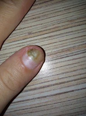 Грибок ногтя большого пальца на руке - Вопрос дерматологу - 03 Онлайн