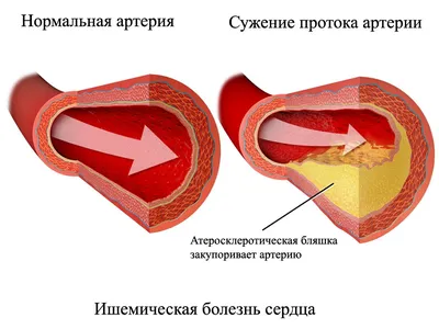 Гипертоническая болезнь (гипертония). Повышенное артериальное давление.