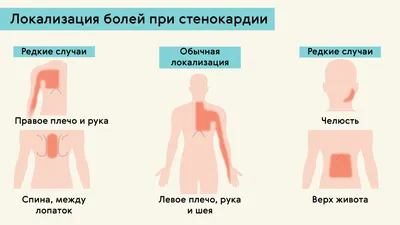 Грудная жаба - перевод 3D иллюстрация штока. иллюстрации насчитывающей  сосуды - 82630136