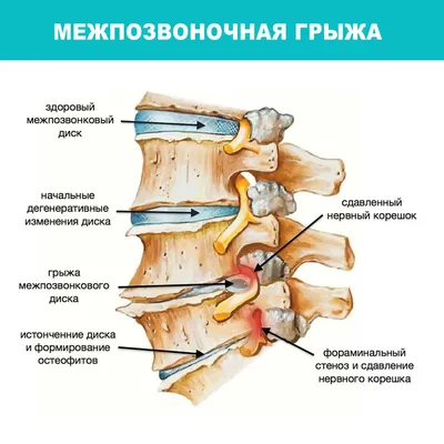 Симптомы и лечение грыжи позвоночника: 3 эффективных подхода в медицине