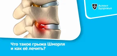 Что такое грыжа Шморля и как её лечить? — Аспект Здоровья