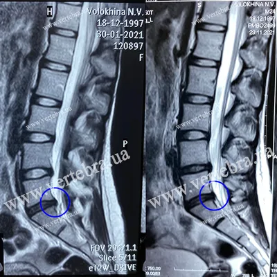 Результаты лечения межпозвонковых грыж и протрузий без операции, снимки МРТ  до и после, отзывы - Vertebra