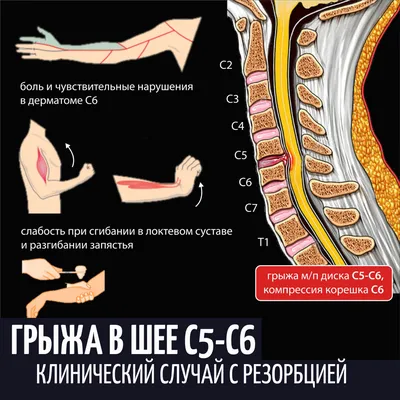 Грыжа в шее размером 1 см исчезла, а хорошее настроение появилось.  Нейромемоблог | Пикабу