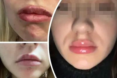 Начался некроз губ: три истории девушек, пострадавших от рук косметолога