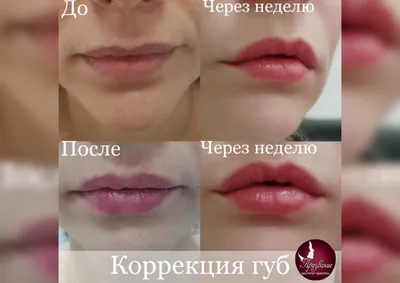 Увлажнение и моделирование губ | Институт красоты «Призвание»