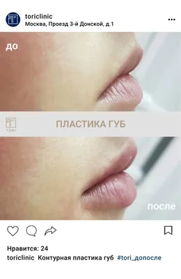 Контурная пластика губ гиалуроновой кислотой, цены в Москве