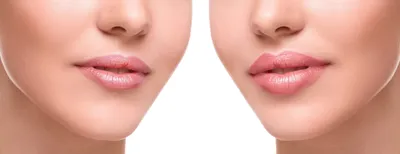 Как увеличить губы естественным путем - \
