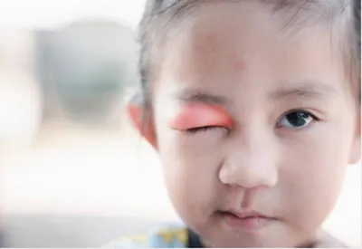 Ячмень у ребенка на глазу: чем лечить