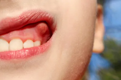 Що робити, якщо у дитини утворився свищ на яснах молочного зуба: способи  лікування в домашніх умовах | Блог про дитяче здоров'я