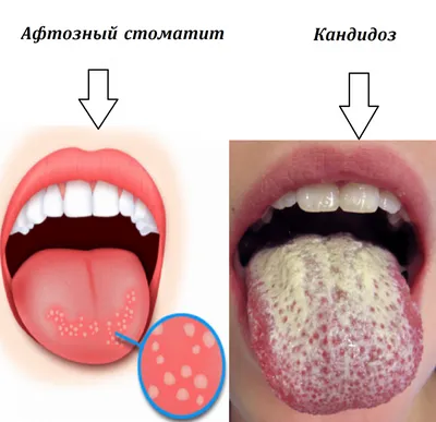 Как избавиться от жжения во рту?. Статьи «ДОКТОР ДЕНТ».