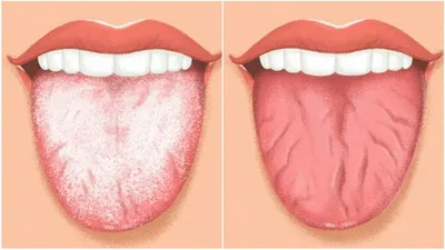 Налет на языке – причины, симптомы, лечение 👅 Как убрать белый налет на  языке 😛 | CIS