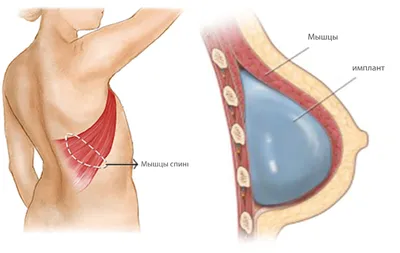 Грудные импланты: виды, размеры, формы и сколько стоят – Mammaclinic