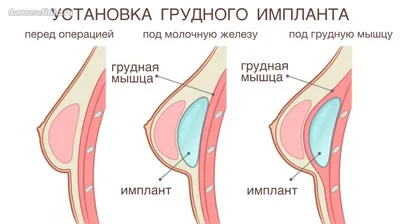 Грудные импланты: виды, размеры, формы и сколько стоят – Mammaclinic