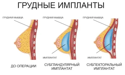 Маммопластика (пластика груди) в Москве 2019: цены, сделать операцию у  профессионалов | Клиника Доктора Росса