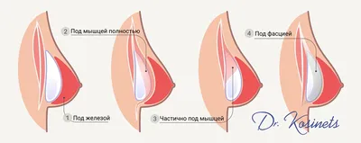 Подтяжка и увеличение груди - Майский И. А.